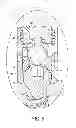 Fig. 04 - Extended tab bone screw system