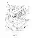 Fig. 04 - System and method for correction of a spinal disorder