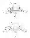 Fig. 05 - System and method for correction of a spinal disorder