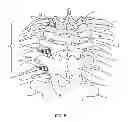 Fig. 07 - System and method for correction of a spinal disorder