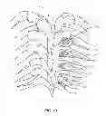 Fig. 09 - System and method for correction of a spinal disorder