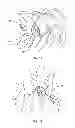 Fig. 10 - System and method for correction of a spinal disorder