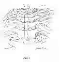 Fig. 12 - System and method for correction of a spinal disorder