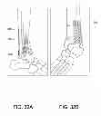 Fig. 22 - Systems and methods for using polyaxial plates