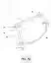 Fig. 11 - IMPLANT MODULE AND METHOD FOR REPAIRING AVULSION FRACTURE