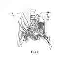 Fig. 03 - Methods and systems for treating acute heart failure by neuromodulation