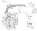 Fig. 01 - Apparatuses and methods using the role of ventricular electrical delay to predict left ventricular remodeling with cardiac resynchronization therapy