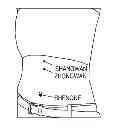 Fig. 01 - Heat Patch For Obesity
