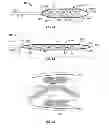Fig. 02 - IMPLANTABLE PADDLE LEAD COMPRISING COMPRESSIVE LONGITUDINAL MEMBERS FOR SUPPORTING ELECTRODES AND METHOD OF FABRICATION