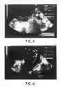 Fig. 04 - IMPLANTABLE PRODUCT WITH IMPROVED AQUEOUS INTERFACE CHARACTERISTICS AND METHODS FOR MAKING AND USING THE SAME