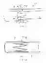 Fig. 09 - Endoluminal prosthesis with a valve arrangement