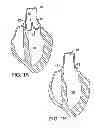 Fig. 02 - Methods of measuring heart valve annuluses for valve replacement