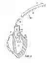 Fig. 05 - Methods of measuring heart valve annuluses for valve replacement
