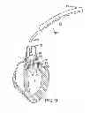 Fig. 06 - Methods of measuring heart valve annuluses for valve replacement