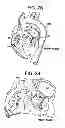 Fig. 04 - METHOD AND SYSTEM FOR PLICATING TISSUE IN A MINIMALLY INVASIVE MEDICAL PROCEDURE FOR THE TREATMENT OF MITRAL VALVE REGURGITATION