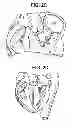 Fig. 05 - METHOD AND SYSTEM FOR PLICATING TISSUE IN A MINIMALLY INVASIVE MEDICAL PROCEDURE FOR THE TREATMENT OF MITRAL VALVE REGURGITATION