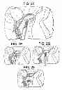 Fig. 06 - METHOD AND SYSTEM FOR PLICATING TISSUE IN A MINIMALLY INVASIVE MEDICAL PROCEDURE FOR THE TREATMENT OF MITRAL VALVE REGURGITATION
