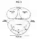Fig. 07 - METHOD AND SYSTEM FOR PLICATING TISSUE IN A MINIMALLY INVASIVE MEDICAL PROCEDURE FOR THE TREATMENT OF MITRAL VALVE REGURGITATION