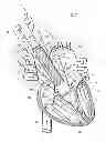 Fig. 10 - Prosthetic vascular conduit and assembly method