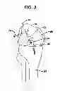 Fig. 04 - Methods for ligament reconstruction