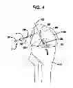 Fig. 05 - Methods for ligament reconstruction