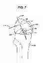 Fig. 08 - Methods for ligament reconstruction