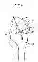Fig. 09 - Methods for ligament reconstruction