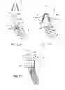 Fig. 33 - Shape memory dental retention systems