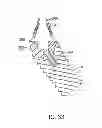 Fig. 35 - Shape memory dental retention systems