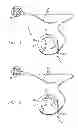 Fig. 02 - SMOOTH SURFACE GASTRIC BAND DEVICE AND SYSTEM