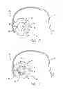 Fig. 03 - SMOOTH SURFACE GASTRIC BAND DEVICE AND SYSTEM