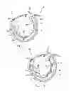 Fig. 04 - SMOOTH SURFACE GASTRIC BAND DEVICE AND SYSTEM