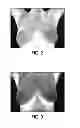 Fig. 03 - BREAST CANCER PRECURSOR EVALUATION SYSTEM AND PROACTIVE BREAST WELLNESS PROGRAM