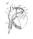 Fig. 02 - METHODS AND DEVICES FOR INTRA-ATRIAL SHUNTS HAVING ADJUSTABLE SIZES