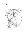 Fig. 06 - METHODS AND DEVICES FOR INTRA-ATRIAL SHUNTS HAVING ADJUSTABLE SIZES