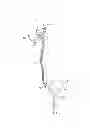 Fig. 07 - Renal nerve denervation via the renal pelvis