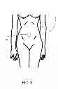 Fig. 04 - Umbilical splint and method of use