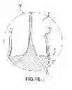 Fig. 07 - COMPOSITE IMPLANT