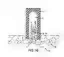 Fig. 08 - COMPOSITE IMPLANT