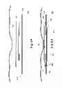 Fig. 07 - Hernia patch