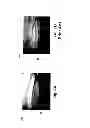 Fig. 08 - Hernia patch