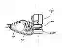 Fig. 01 - Methods, instruments and devices for extragastric reduction of stomach volume