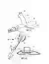 Fig. 22 - Methods, instruments and devices for extragastric reduction of stomach volume