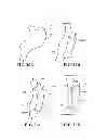 Fig. 44 - Methods, instruments and devices for extragastric reduction of stomach volume