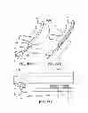 Fig. 52 - Methods, instruments and devices for extragastric reduction of stomach volume