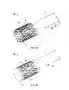 Fig. 04 - Gastrointestinal implant and methods for use