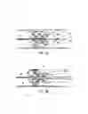 Fig. 03 - Integrated embolic protection devices