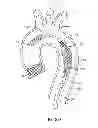 Fig. 07 - Integrated embolic protection devices