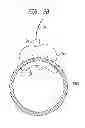 Fig. 04 - Instrument and methods for surgically closing percutaneous punctures