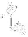 Fig. 35 - Instrument and methods for surgically closing percutaneous punctures